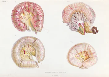 Die äußere Oberfläche der mit Cholera infizierten Eingeweide, aus Anatomie Pathologique du Cholera Morbus, von Nikolai Ivanovich Pirogov (1810-81) veröffentlicht in St. Petersburg, 1849