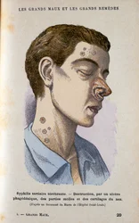 Symptome der tertiären Phase der Syphilis, 19. Jahrhundert