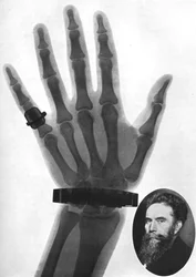 Röntgenaufnahme einer Hand, 1926