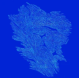 Querschnitt von fibro-nukleären Tumoren