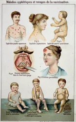 Tafel zur Darstellung der verschiedenen Formen syphilitischer Erkrankungen und der Gefahren der Impfung - in Bilz