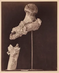 Leutnant Goodwin, verstorben, nicht vereinigte Schussfraktur des oberen Drittels des rechten Oberschenkels, sieben Monate nach der Verletzung, aus dem fotografischen Katalog der chirurgischen Abteilung