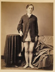 Private G. W. Warrington, Genesung ohne Amputation nach Schussfraktur der rechten Kniescheibe, aus dem fotografischen Katalog der chirurgischen Abteilung