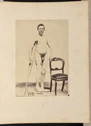 Konsolidierte Schussfraktur des mittleren Drittels des rechten Oberschenkels