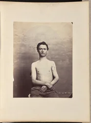 Erholung nach Entfernung des Kopfes des linken Humerus bei Schussfraktur